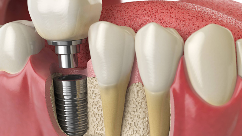Qué es un implante - Clínica dental Jose Luis Sierra